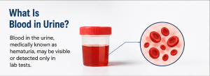 What Is Blood in Urine?